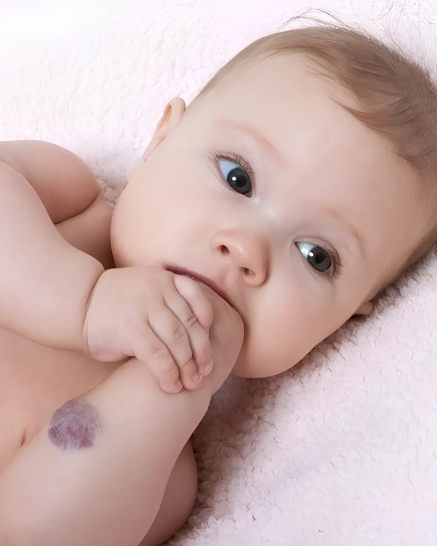 Birthmarks at Cinch Clinics